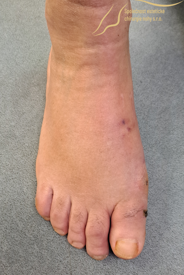 pooperační fotka vbočeného palce pravé nohy 4 týdny po operaci